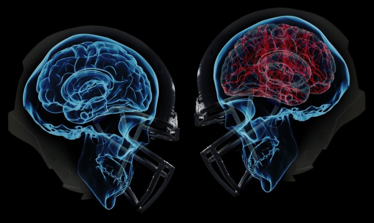 Post Concussion Care in Wasco & Bakersfield